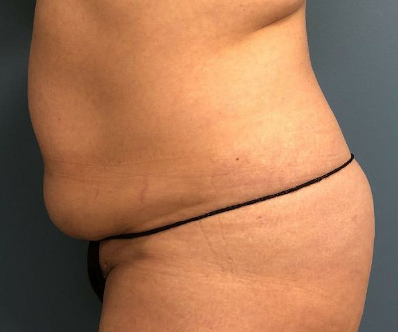 Tummy Tuck Before & After Gallery - Patient 246561 - Image 3