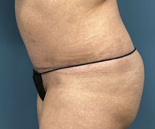 Tummy Tuck Before & After Gallery - Patient 246561 - Image 4