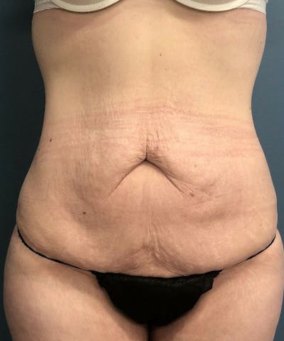 Tummy Tuck Before & After Gallery - Patient 251664 - Image 1