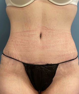 Tummy Tuck Before & After Gallery - Patient 251664 - Image 2