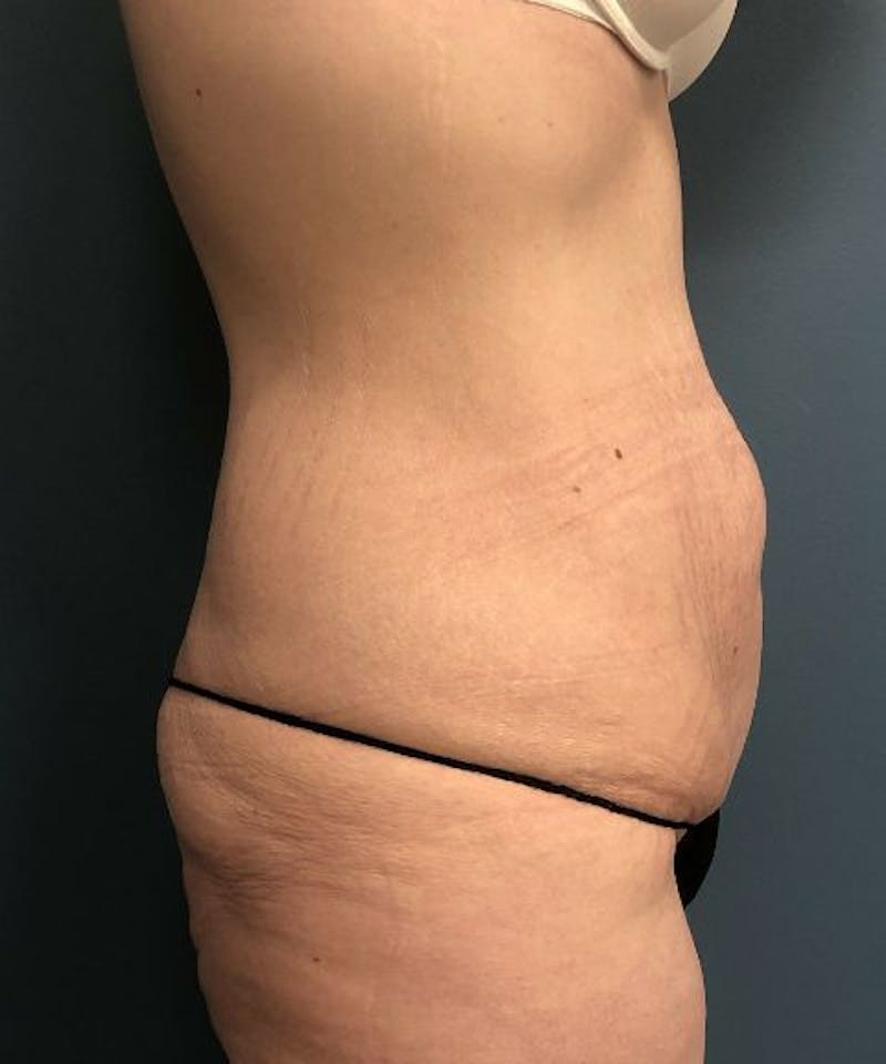 Tummy Tuck Before & After Gallery - Patient 251664 - Image 3