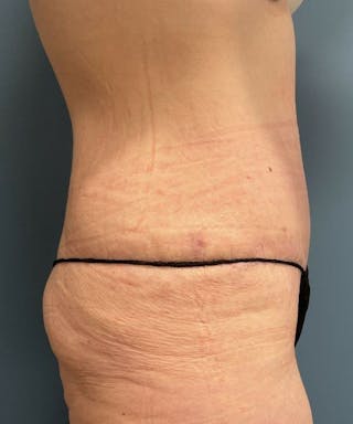 Tummy Tuck Before & After Gallery - Patient 251664 - Image 4