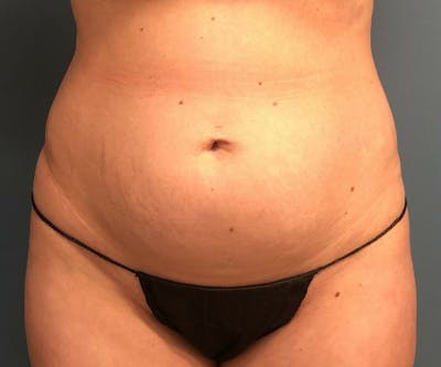 Tummy Tuck Before & After Gallery - Patient 321259 - Image 1