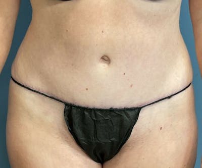 Tummy Tuck Before & After Gallery - Patient 321259 - Image 2