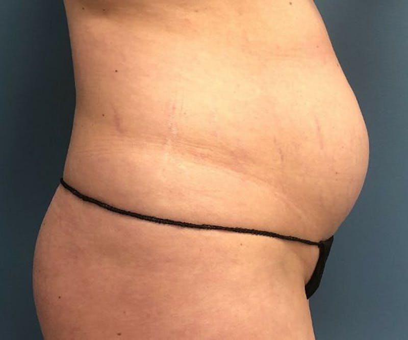 Tummy Tuck Before & After Gallery - Patient 321259 - Image 3