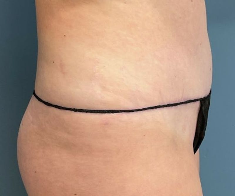 Tummy Tuck Before & After Gallery - Patient 321259 - Image 4
