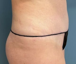 Tummy Tuck Before & After Gallery - Patient 321259 - Image 4
