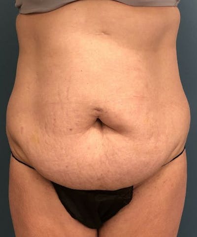 Tummy Tuck Before & After Gallery - Patient 386765 - Image 1
