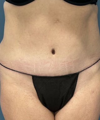 Tummy Tuck Before & After Gallery - Patient 386765 - Image 2