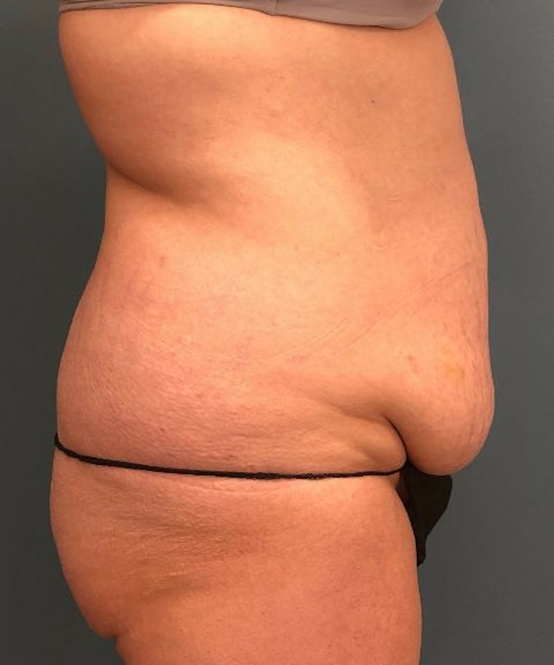 Tummy Tuck Before & After Gallery - Patient 386765 - Image 3