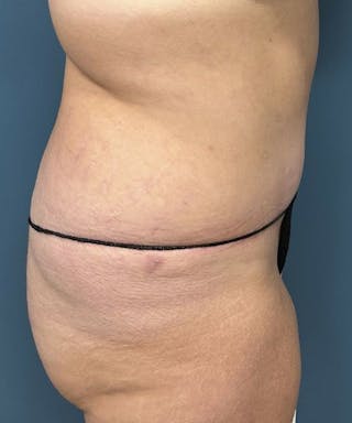 Tummy Tuck Before & After Gallery - Patient 386765 - Image 4