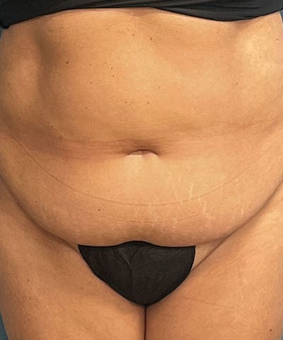 Tummy Tuck Before & After Gallery - Patient 302741 - Image 1