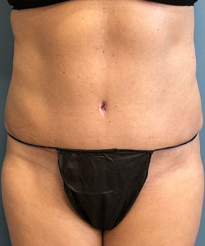 Tummy Tuck Before & After Gallery - Patient 302741 - Image 2