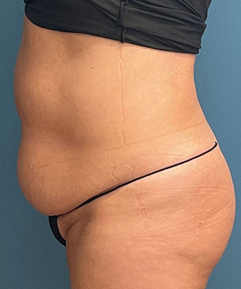 Tummy Tuck Before & After Gallery - Patient 302741 - Image 3