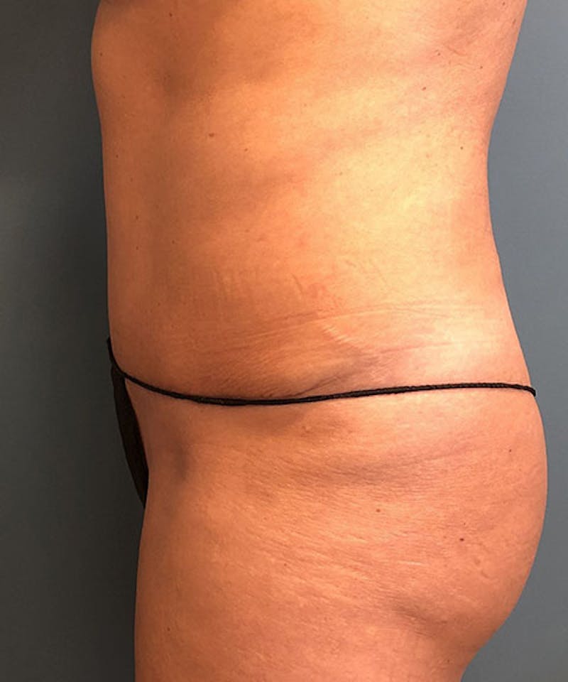 Tummy Tuck Before & After Gallery - Patient 302741 - Image 4