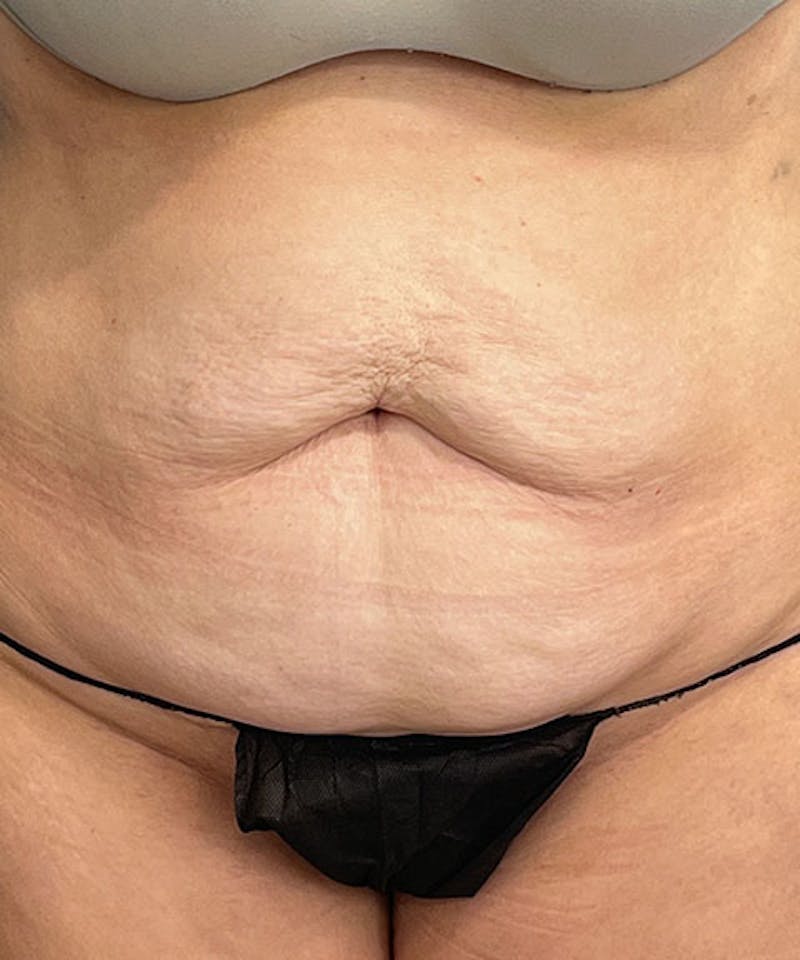 Tummy Tuck Before & After Gallery - Patient 276057 - Image 1