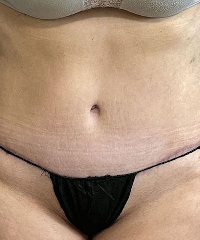 Tummy Tuck Before & After Gallery - Patient 276057 - Image 2
