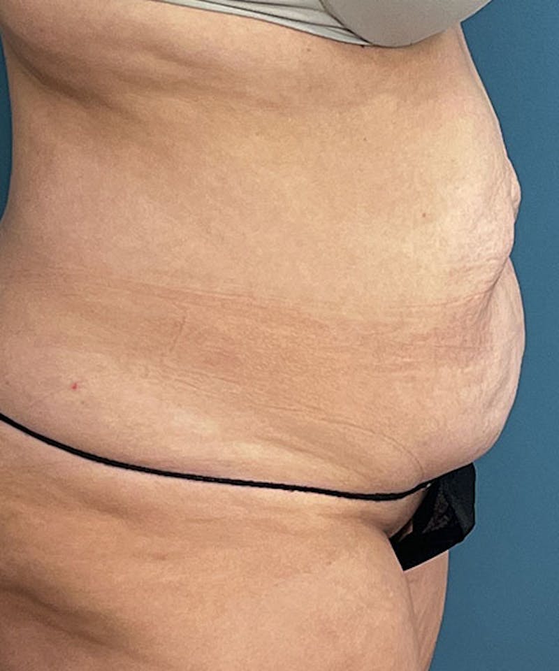 Tummy Tuck Before & After Gallery - Patient 276057 - Image 3
