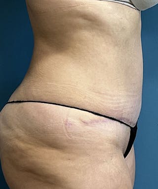 Tummy Tuck Before & After Gallery - Patient 276057 - Image 4