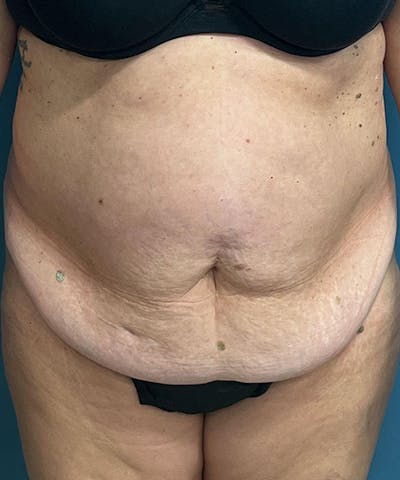 Tummy Tuck Before & After Gallery - Patient 365779 - Image 1