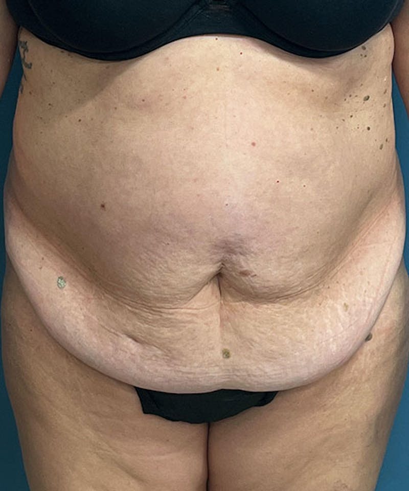 Tummy Tuck Before & After Gallery - Patient 365779 - Image 1