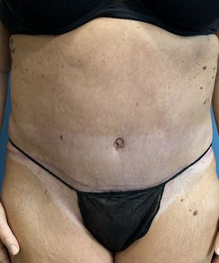 Tummy Tuck Before & After Gallery - Patient 365779 - Image 2