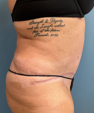 Tummy Tuck Before & After Gallery - Patient 365779 - Image 4