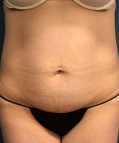 Tummy Tuck Before & After Gallery - Patient 205526 - Image 1