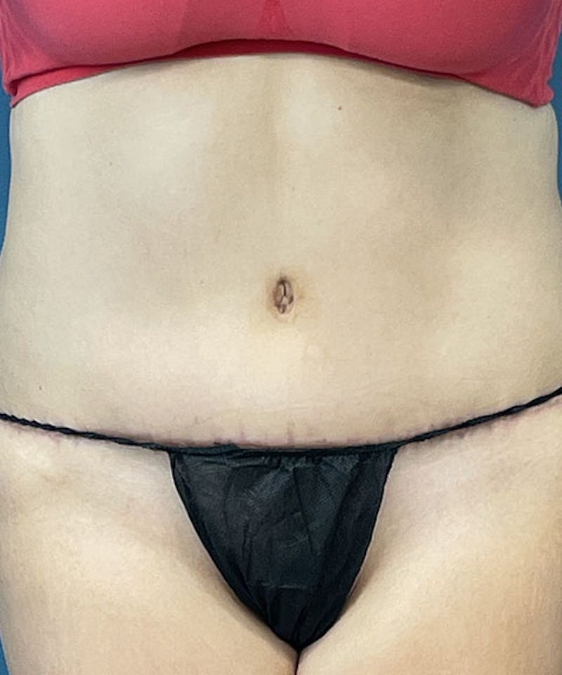 Tummy Tuck Before & After Gallery - Patient 205526 - Image 2