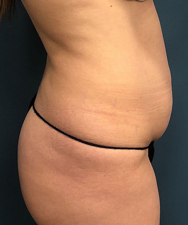 Tummy Tuck Before & After Gallery - Patient 205526 - Image 3