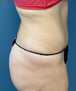 Tummy Tuck Before & After Gallery - Patient 205526 - Image 4