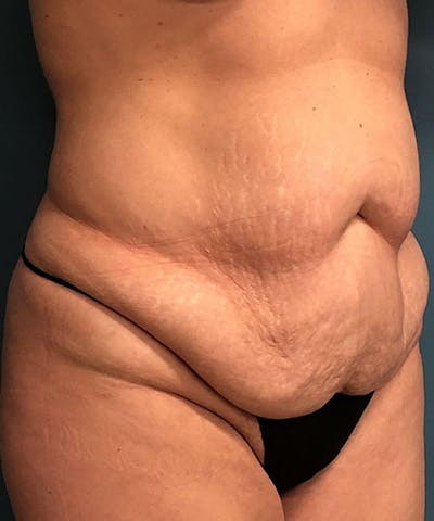 Tummy Tuck Before & After Gallery - Patient 391215 - Image 1