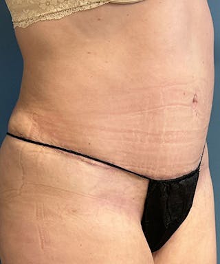 Tummy Tuck Before & After Gallery - Patient 391215 - Image 2