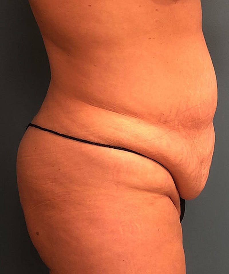 Tummy Tuck Before & After Gallery - Patient 391215 - Image 3