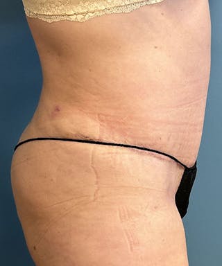 Tummy Tuck Before & After Gallery - Patient 391215 - Image 4