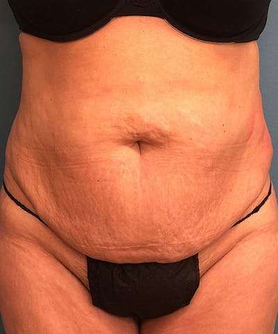 Tummy Tuck Before & After Gallery - Patient 129607 - Image 1