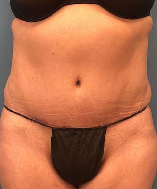 Tummy Tuck Before & After Gallery - Patient 129607 - Image 2