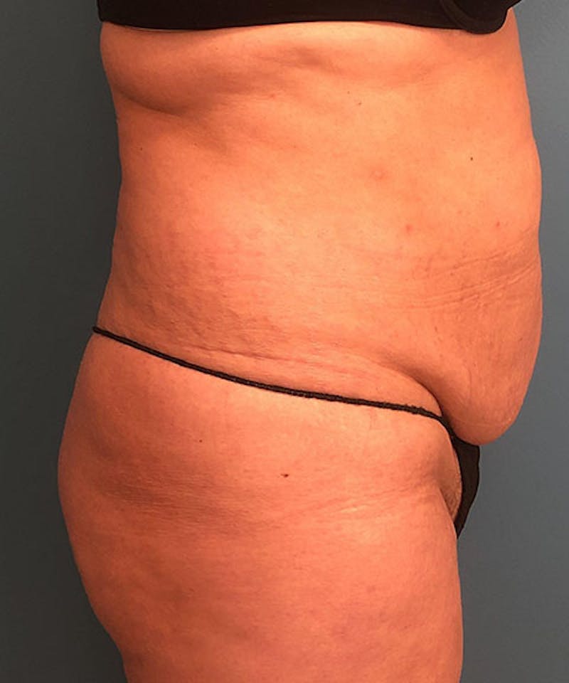 Tummy Tuck Before & After Gallery - Patient 129607 - Image 3