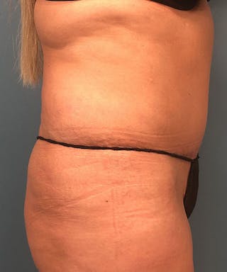 Tummy Tuck Before & After Gallery - Patient 129607 - Image 4
