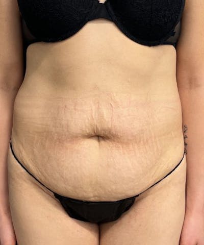Tummy Tuck Before & After Gallery - Patient 424629 - Image 1