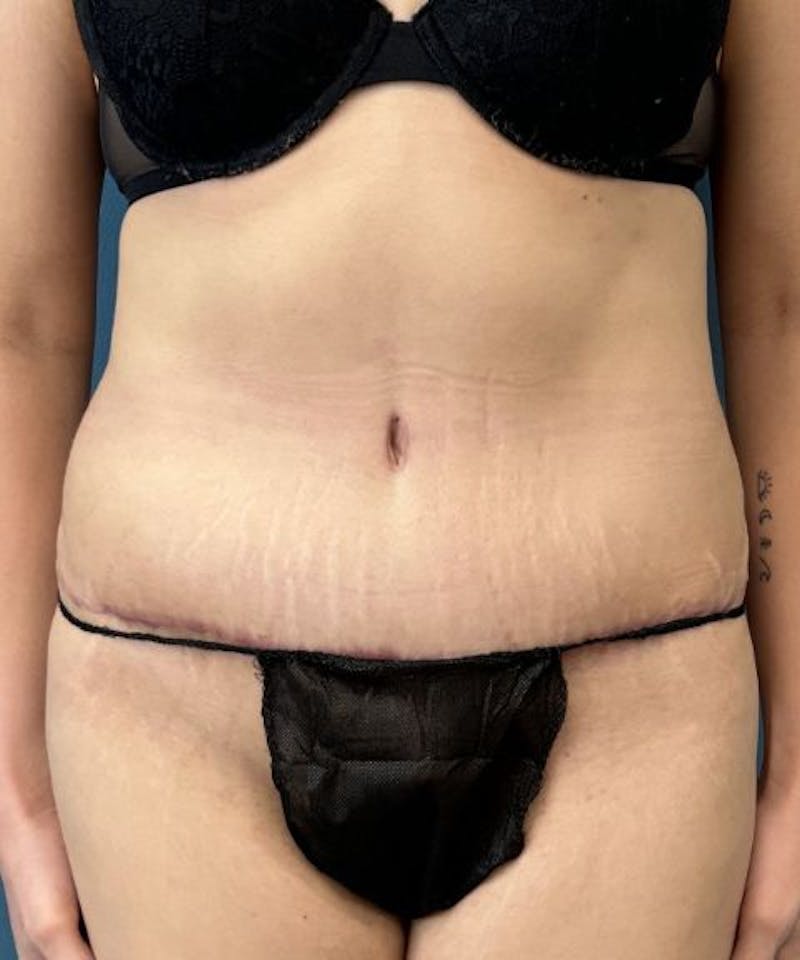 Tummy Tuck Before & After Gallery - Patient 424629 - Image 2