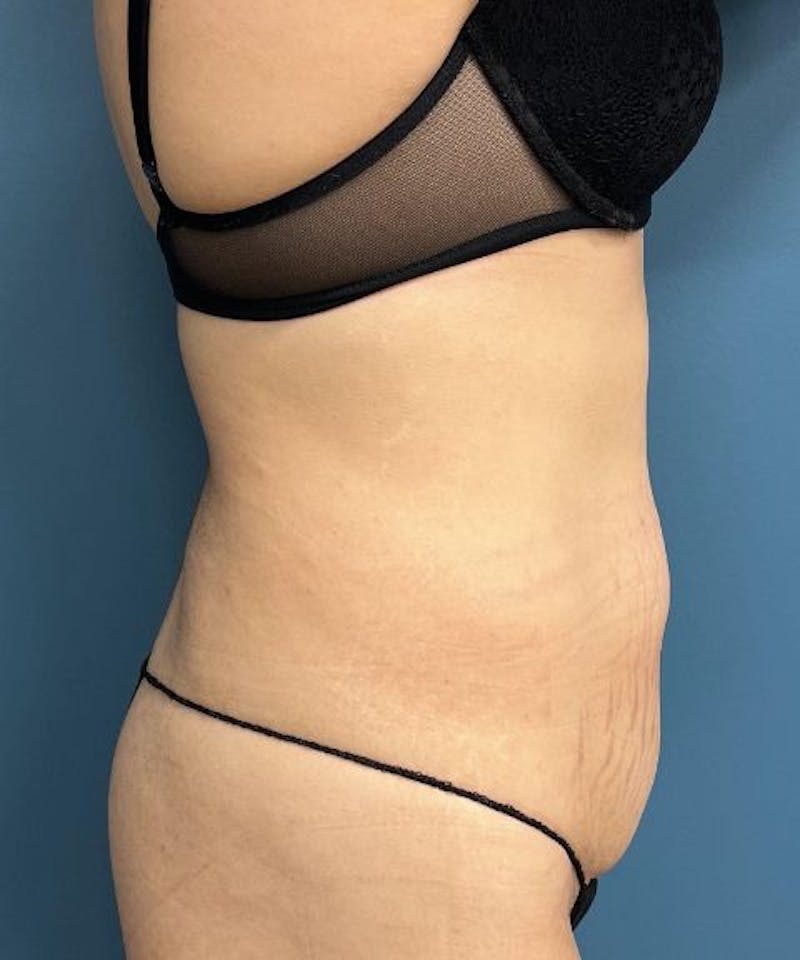 Tummy Tuck Before & After Gallery - Patient 424629 - Image 3