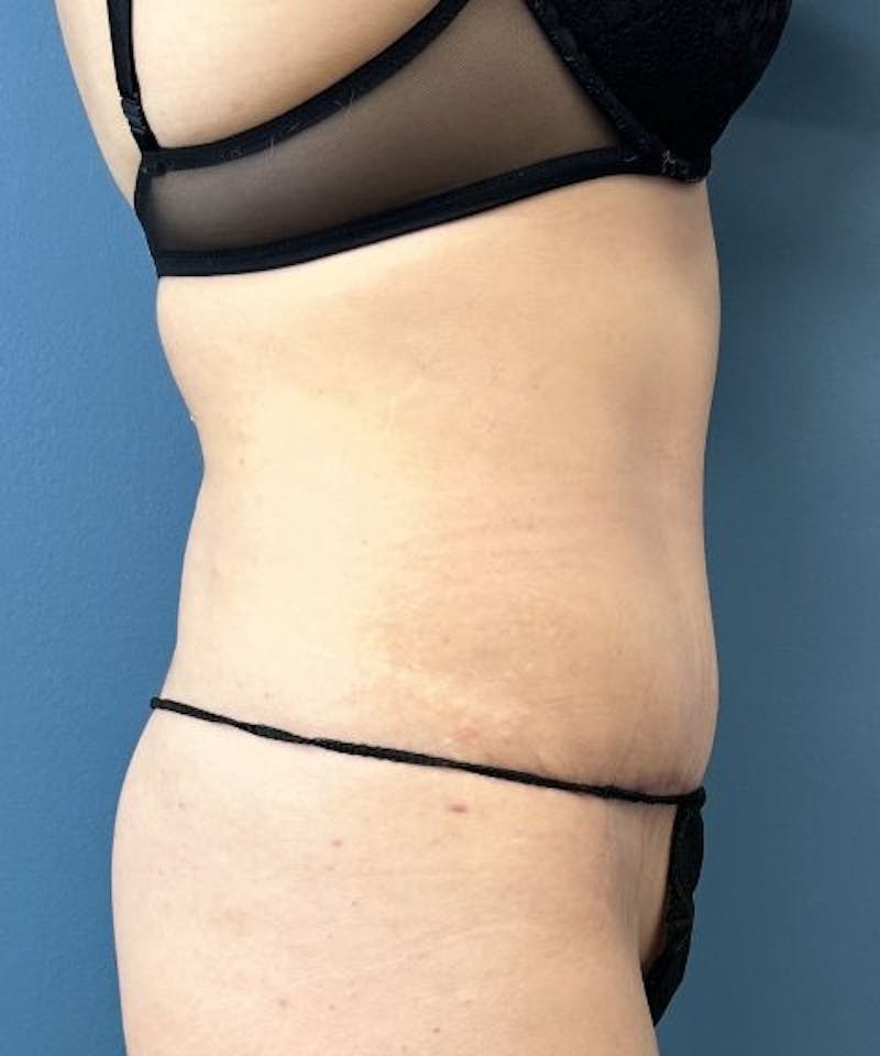 Tummy Tuck Before & After Gallery - Patient 424629 - Image 4