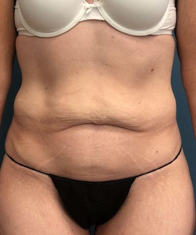 Tummy Tuck Before & After Gallery - Patient 200424 - Image 1