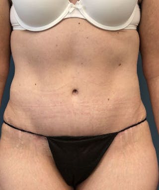 Tummy Tuck Before & After Gallery - Patient 200424 - Image 2