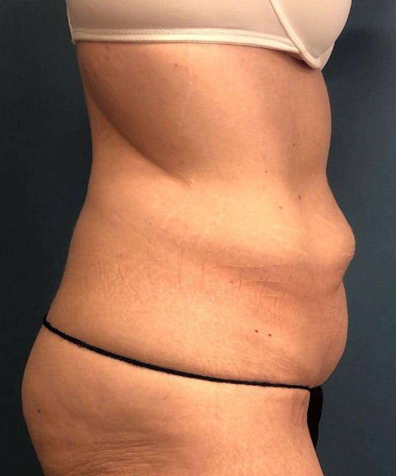 Tummy Tuck Before & After Gallery - Patient 200424 - Image 3