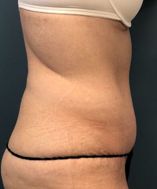 Tummy Tuck Before & After Gallery - Patient 200424 - Image 4
