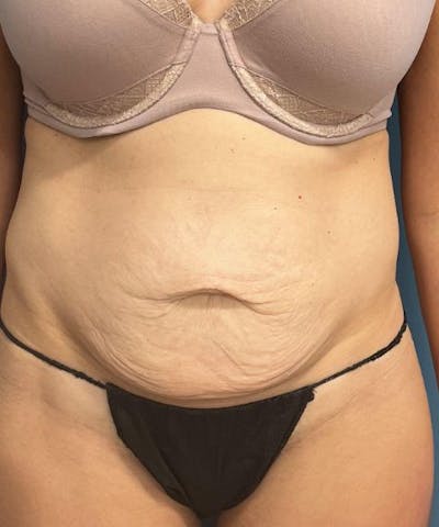 Tummy Tuck Before & After Gallery - Patient 159279 - Image 1