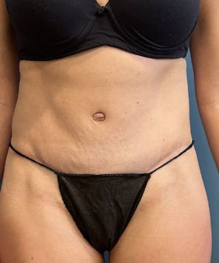 Tummy Tuck Before & After Gallery - Patient 159279 - Image 2