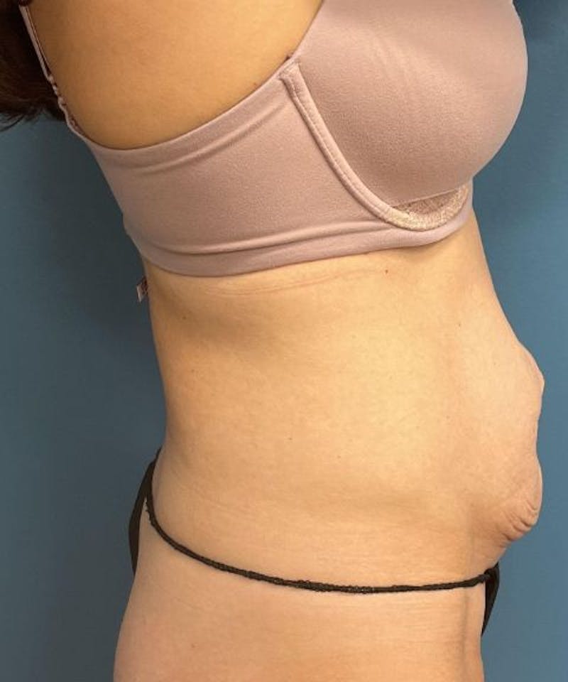 Tummy Tuck Before & After Gallery - Patient 159279 - Image 3